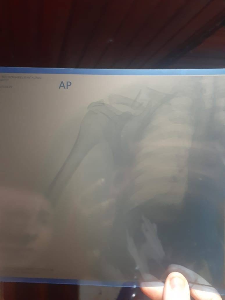 Motociclista sofre grave acidente e precisa de ajuda urgente no Km 42, PY