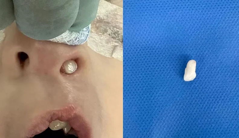 Retirado dente do nariz de criança no Paraná