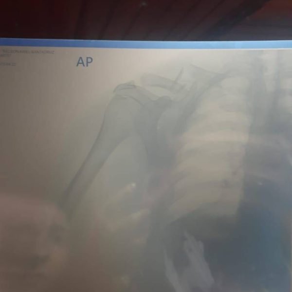 Motociclista sofre grave acidente e precisa de ajuda urgente no Km 42, PY