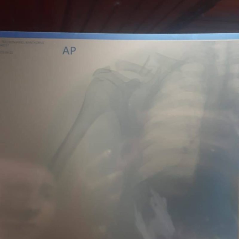 Motociclista sofre grave acidente e precisa de ajuda urgente no Km 42, PY