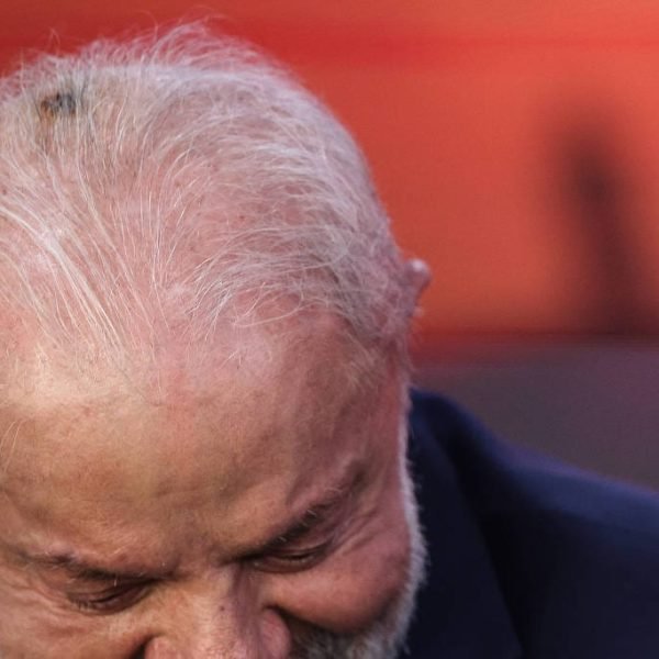 Lula opera lesão basocelular e faz infiltração para tendinite na mão direita